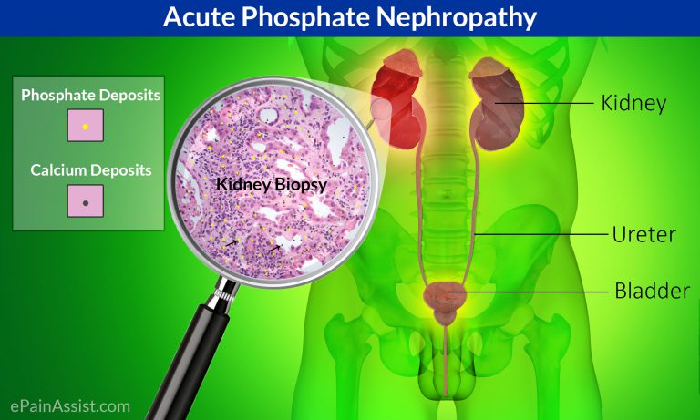Acute Phosphate Nephropathy: Causes, Risk Factors, Signs, Symptoms, Diagnosis, Treatment