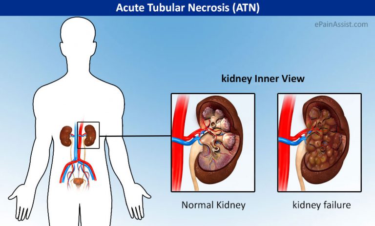 Acute Tubular Necrosis (ATN): Causes, Risk Factors, Symptoms, Diagnosis, Treatment, Prevention