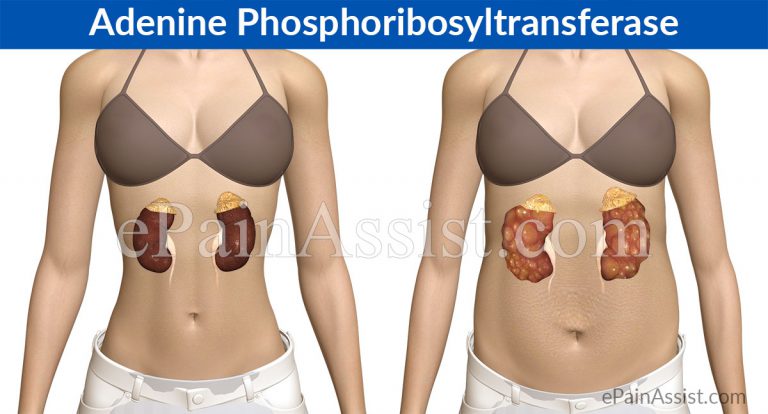 Adenine Phosphoribosyltransferase or APRT Deficiency: Causes, Symptoms, Treatment, Prognosis