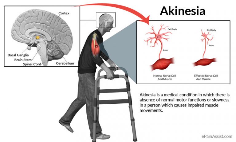 Akinesia: Causes, Symptoms, Treatment