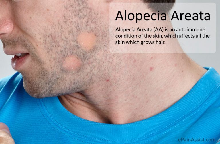 Alopecia Areata (AA): Causes, Patterns, Investigations, Treatment