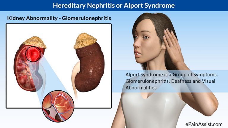 Alport Syndrome or Hereditary Nephritis: Definition, Causes, Risk Factors, Symptoms, Diagnosis, Treatment