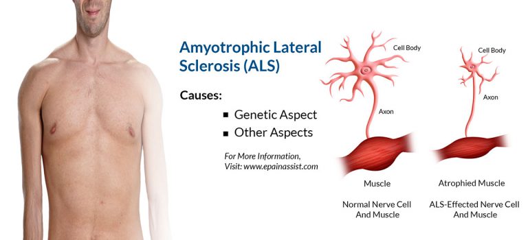 Amyotrophic Lateral Sclerosis (ALS) or Lou Gehrig’s Disease: Symptoms, Treatment