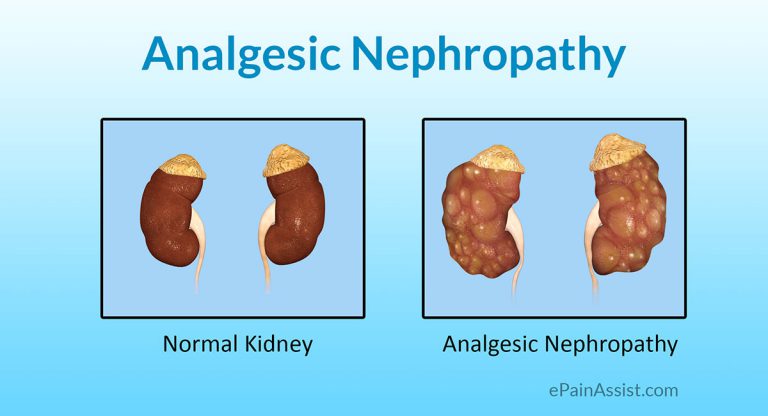 Analgesic Nephropathy: Causes, Risk Factors, Symptoms, Treatment, Prognosis, Prevention