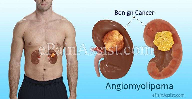 Angiomyolipoma: Changes in Kidney Structure Caused By It, Causes, Symptoms, Treatment