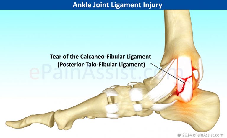 Ankle Joint Ligament Injury: Treatment, Recovery Period, Exercises, Causes, Types, Symptoms
