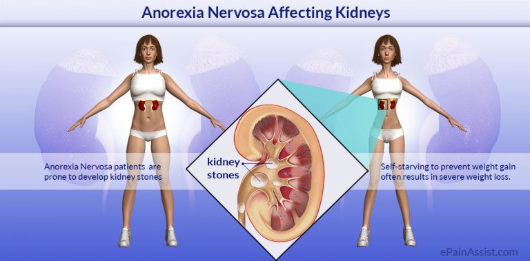 Anorexia Nervosa Affecting Kidneys: Risk Factors, Causes, Complications, Tests, Treatment