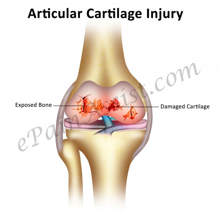 Articular Cartilage Injury: Causes, Symptoms, Signs, Types