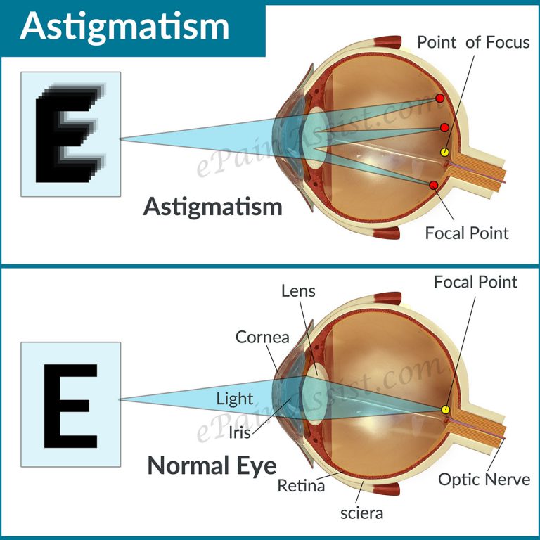 Astigmatism: Causes, Types, Symptoms, Treatment- Lenses, Refractive Surgery