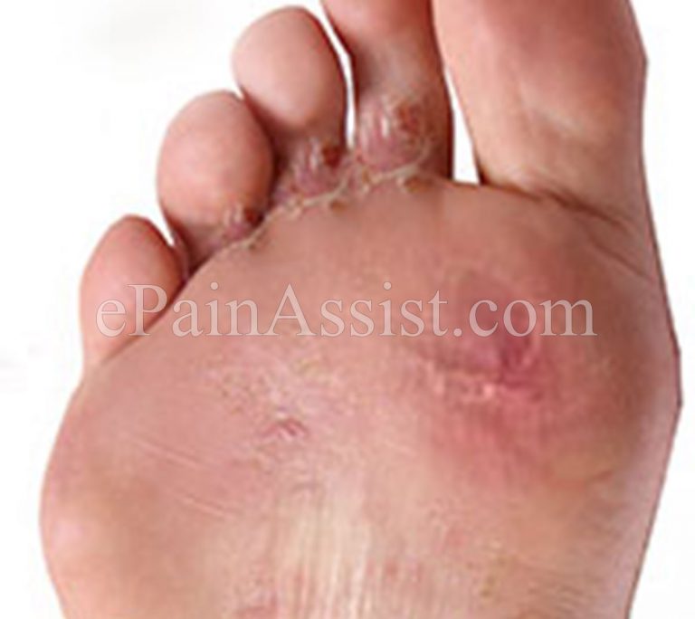 Athlete’s Foot or Tinea Pedis: Symptoms, Causes, Treatment, Prevention- Cotton Socks