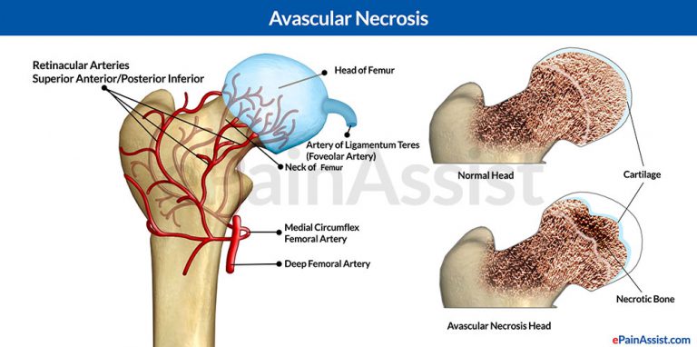 Avascular Necrosis or Osteonecrosis: Types, Epidemiology, Causes. Symptoms, Treatment, Surgery