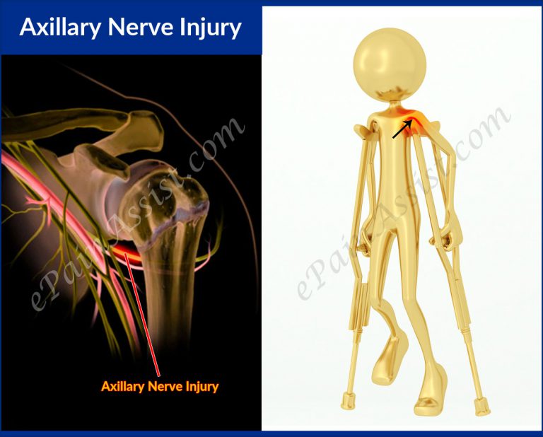 Axillary Nerve Injury or Axillary Neuropathy: Symptoms, Causes, Treatment- EMG
