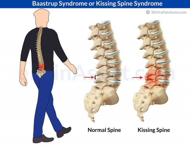 Baastrup Syndrome or Kissing Spine Syndrome in Humans: Causes, Symptoms, Treatment