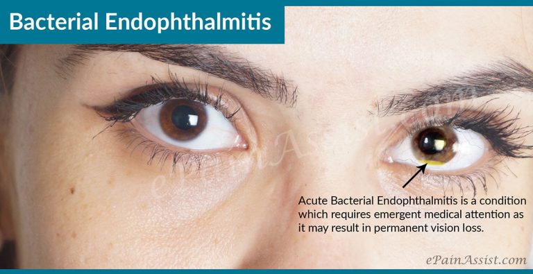 Bacterial Endophthalmitis: Causes, Symptoms, Treatment