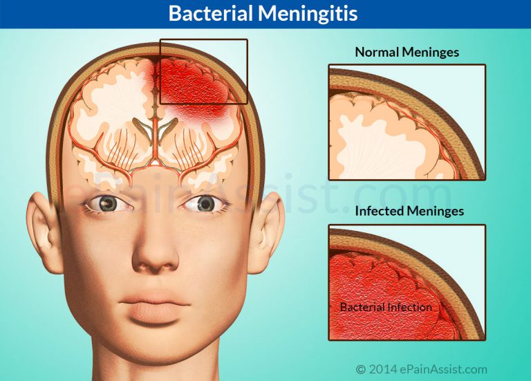 Bacterial Meningitis: Causes, Risk Factors, Symptoms, Diagnosis, Treatment- Antibiotics