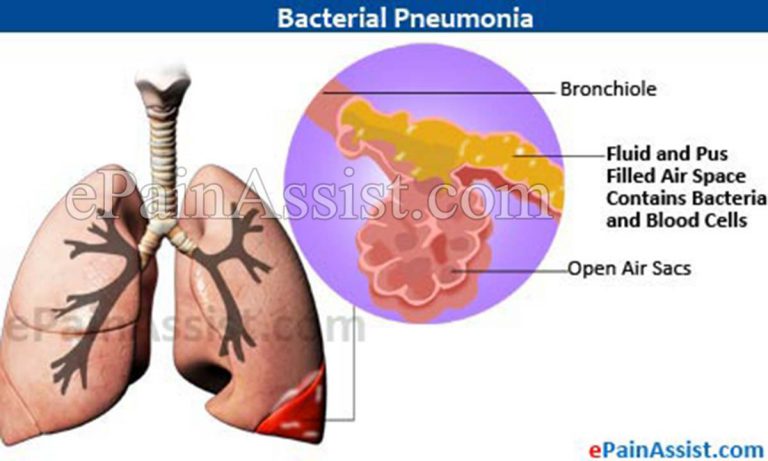 Bacterial Pneumonia: Causes, Signs, Symptoms, Investigations, Treatment