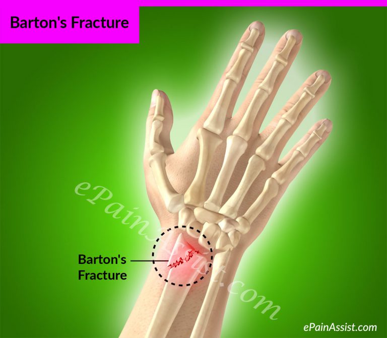 Barton’s Fracture: Causes, Signs, Treatment, PT, Exercises, Investigations
