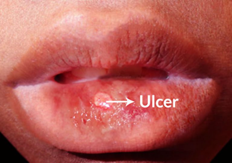 Behcet’s Disease or Behcet’s Syndrome: Causes, Symptoms, Treatment, Investigations