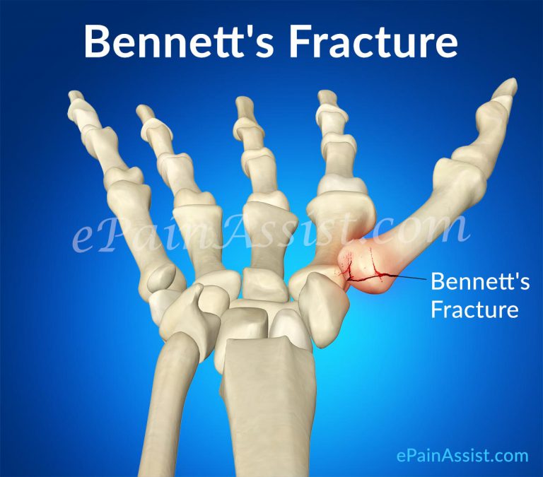 Bennett’s Fracture: Causes, Signs, Treatment, Exercises- Stretching, Strengthening