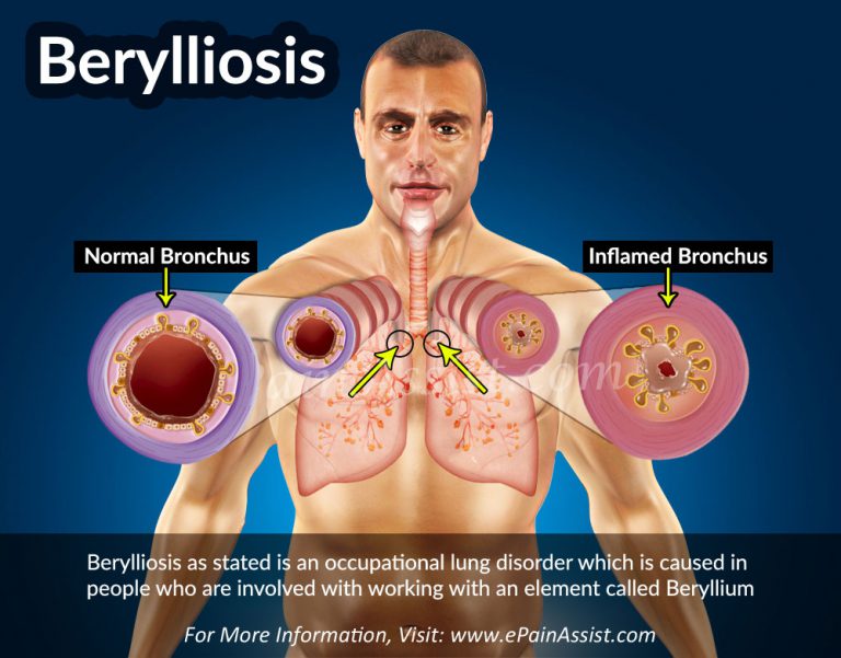 Berylliosis: Causes, Symptoms, Diagnosis, Treatment, Prevention