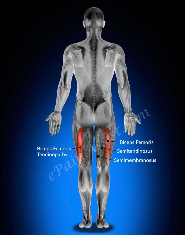 Biceps Femoris Tendinopathy: Symptoms, Treatment- Ice, Massage, Rehab, NSAIDs