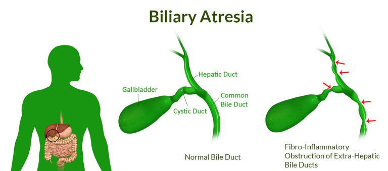What Is Biliary Atresia? Know Its Causes, Symptoms, Signs, Risk Factors, Diagnosis, Treatment, Prognosis