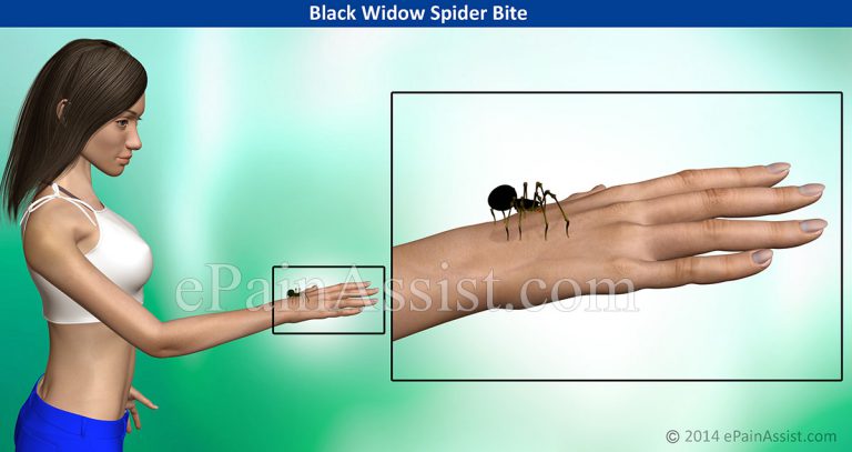 Black Widow Spider Bite: Signs, Symptoms, Treatment- Hot Bath, Ibuprofen, Antivenin