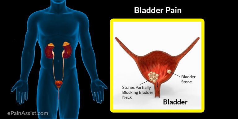 Bladder Pain: Pathophysiology, Etiology, Risk Factors, Signs, Symptoms, Treatment