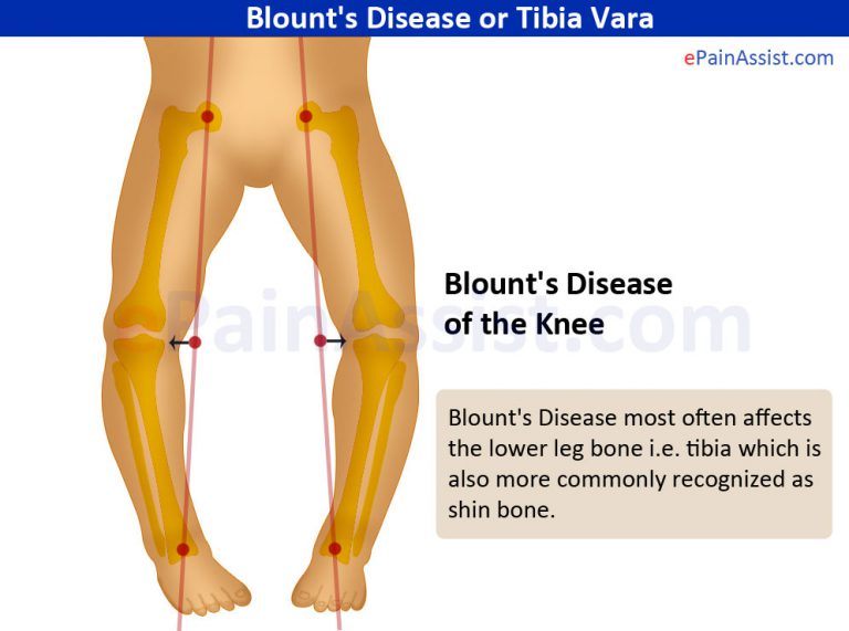 Blount’s Disease or Tibia Vara: Classification, Causes, Signs, Symptoms, Treatment