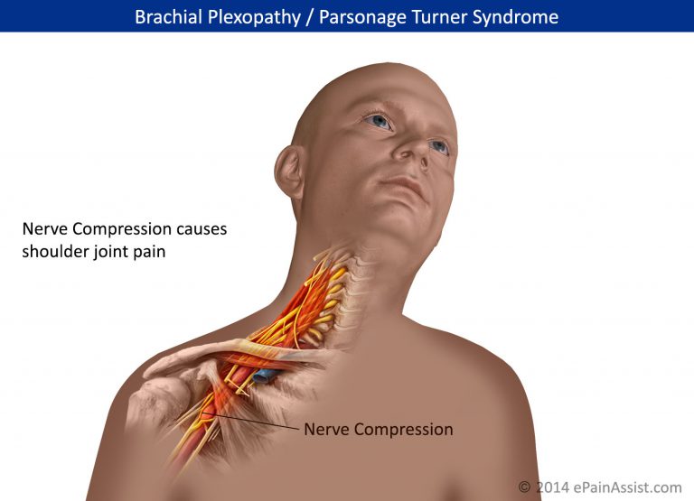 Parsonage Turner Syndrome or Brachial Plexopathy