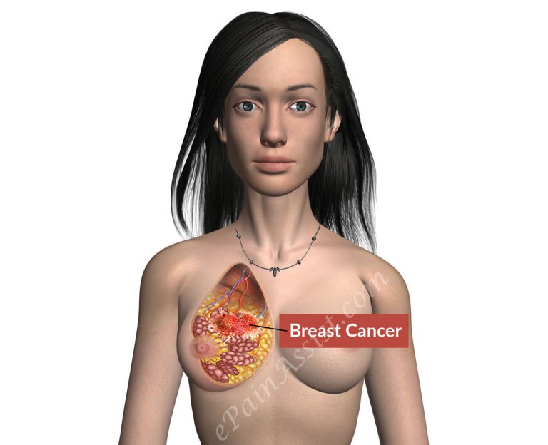 Breast Cancer: Types, Causes, Risk Factors, Signs, Symptoms, Stages, Treatment, Prevention