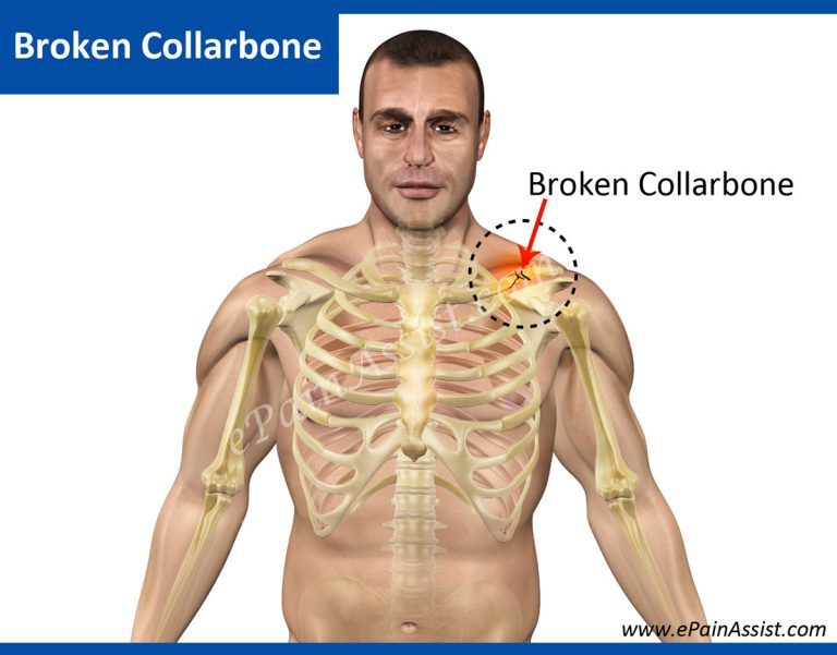 Broken Collarbone or Clavicle Fracture: Causes, Types, Symptoms, Diagnosis, Treatment, Exercises