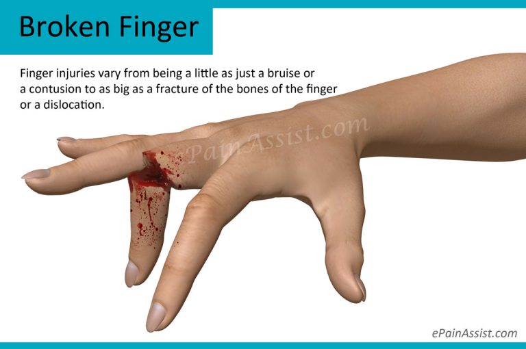 Broken Finger or Fractured Finger: Causes, Signs, Symptoms, Treatment