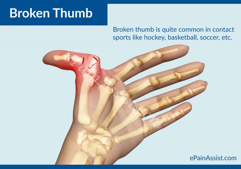 Broken Thumb: Causes, Risk Factors, Symptoms, Treatment, Exercises, Investigations