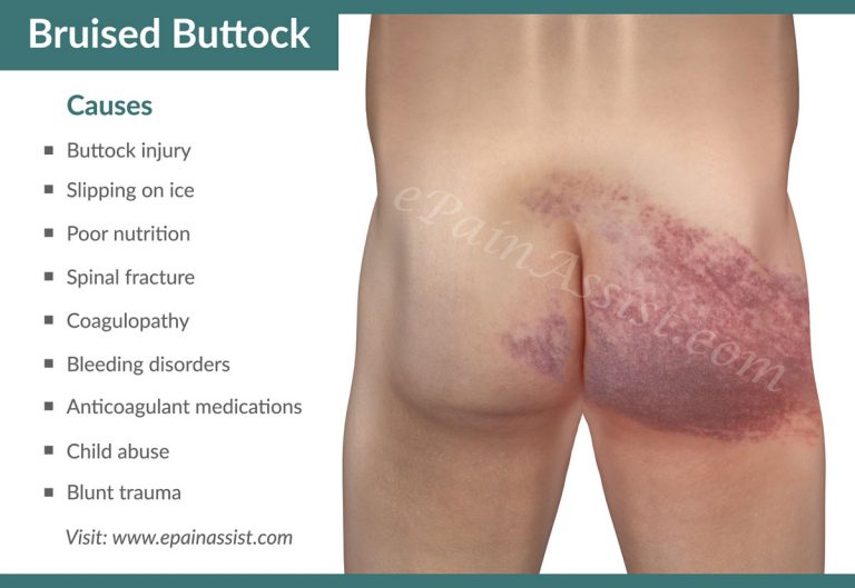 Bruised Buttock or Buttock Contusion: Causes, Signs, Treatment, Exercises