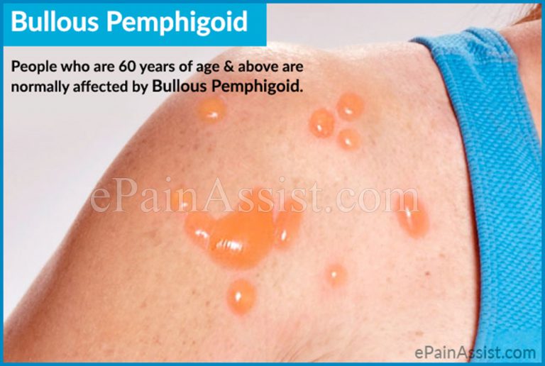 Bullous Pemphigoid: Causes, Symptoms, Treatment, Epidemiology, Complications, Lifestyle Changes