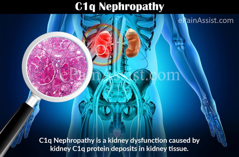 C1q Nephropathy: Causes, Symptoms, Diagnosis, Treatment- Fluid Management