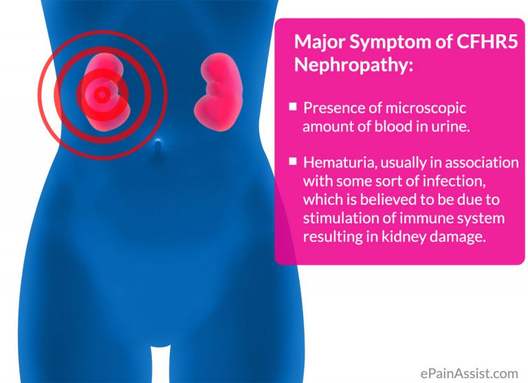 CFHR5 Nephropathy or Troodos Nephropathy: Causes, Symptoms, Treatment, Prognosis