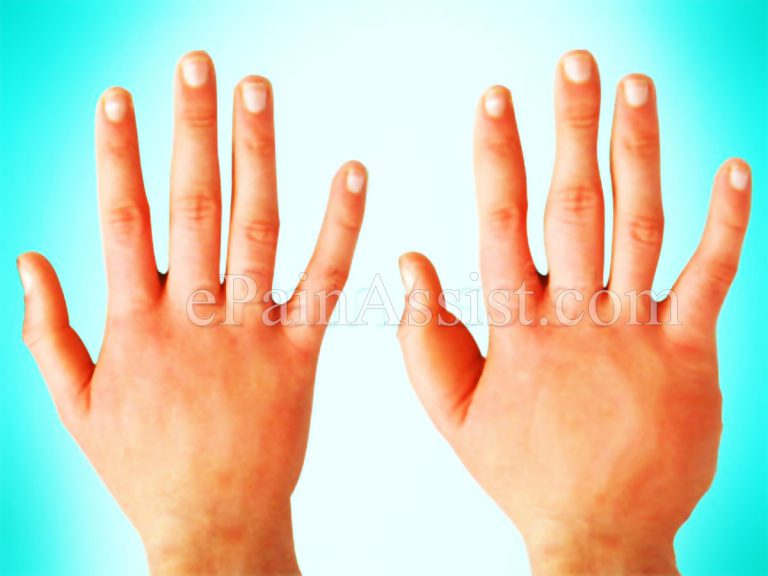 Symptoms & Signs Of Complex Regional Pain Syndrome (CRPS) or Reflex Sympathetic Dystrophy (RSD)