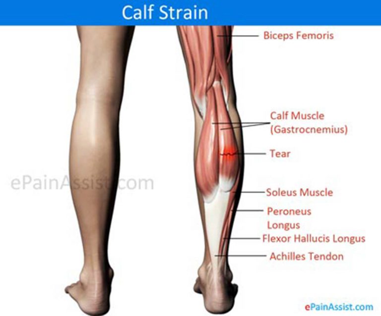 Calf Strain: Causes, Symptoms, Treatment, Prognosis, Recovery