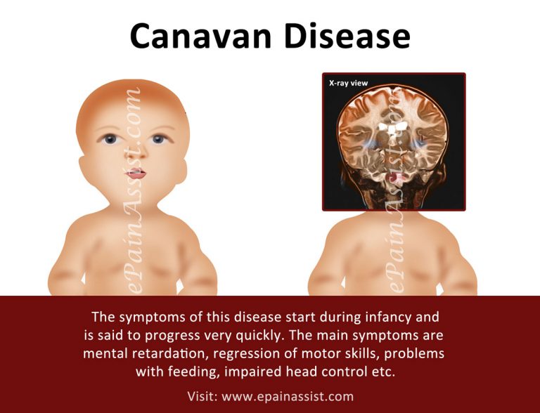 Canavan Disease or Canavan-Van Bogaert-Bertrand Disease: Symptoms, Treatment