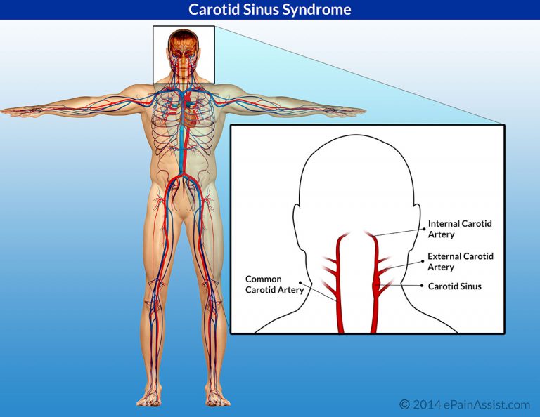 Carotid Sinus Hypersensitivity or Carotid Sinus Syndrome: Risks, Symptoms, Diagnosis, Treatment