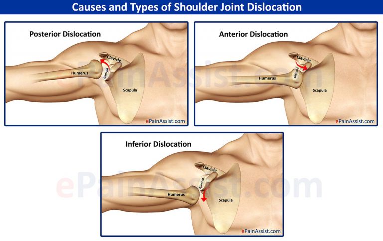 Shoulder Joint Dislocation: Causes, Types, Complications