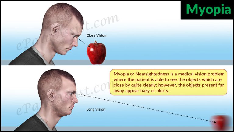 Myopia or Nearsightedness : Causes, Signs, Treatment, Lifestyle Changes