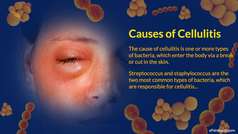 Cellulitis: Causes, Risk Factors, Symptoms, Investigations, Treatment, Prevention