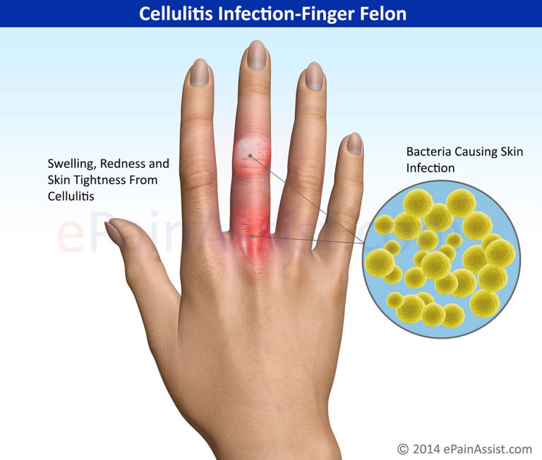 Cellulitis Infection-Finger Felon: Causes, Symptoms, Treatment- Antibiotics, I and D