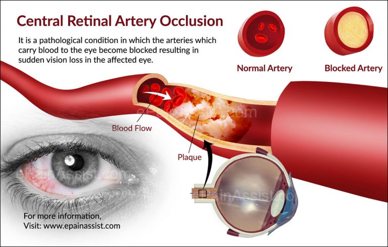 Central Retinal Artery Occlusion: Facts, Causes, Symptoms, Diagnosis, Treatment, Prevention