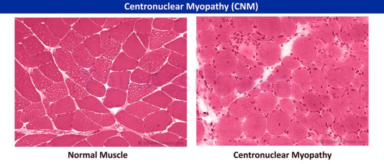 Centronuclear Myopathy (CNM): Causes, Symptoms, Diagnosis, Treatment- PT, Surgery
