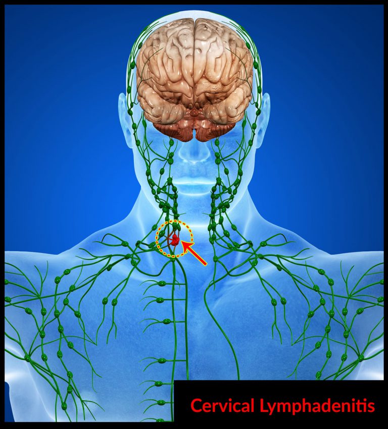What Is Cervical Lymphadenitis? Know its Causes, Symptoms and Treatment