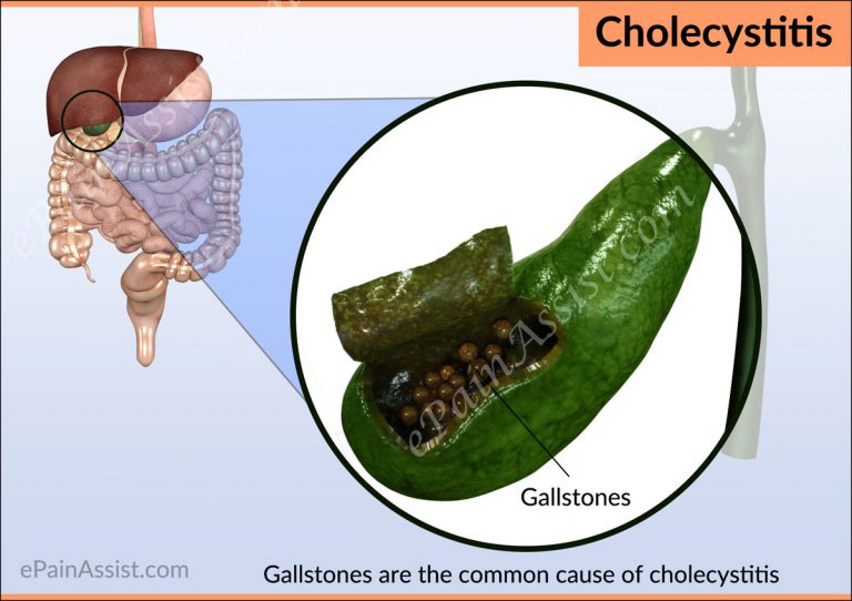 Cholecystitis or Gallbladder Infection: Causes, Risk Factors, Complications, Signs, Symptoms, Tests, Treatment, Prevention